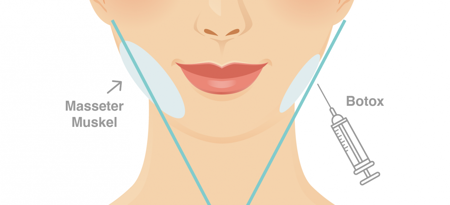 Elegantes Botox Gegen Zhneknirschen Bilder