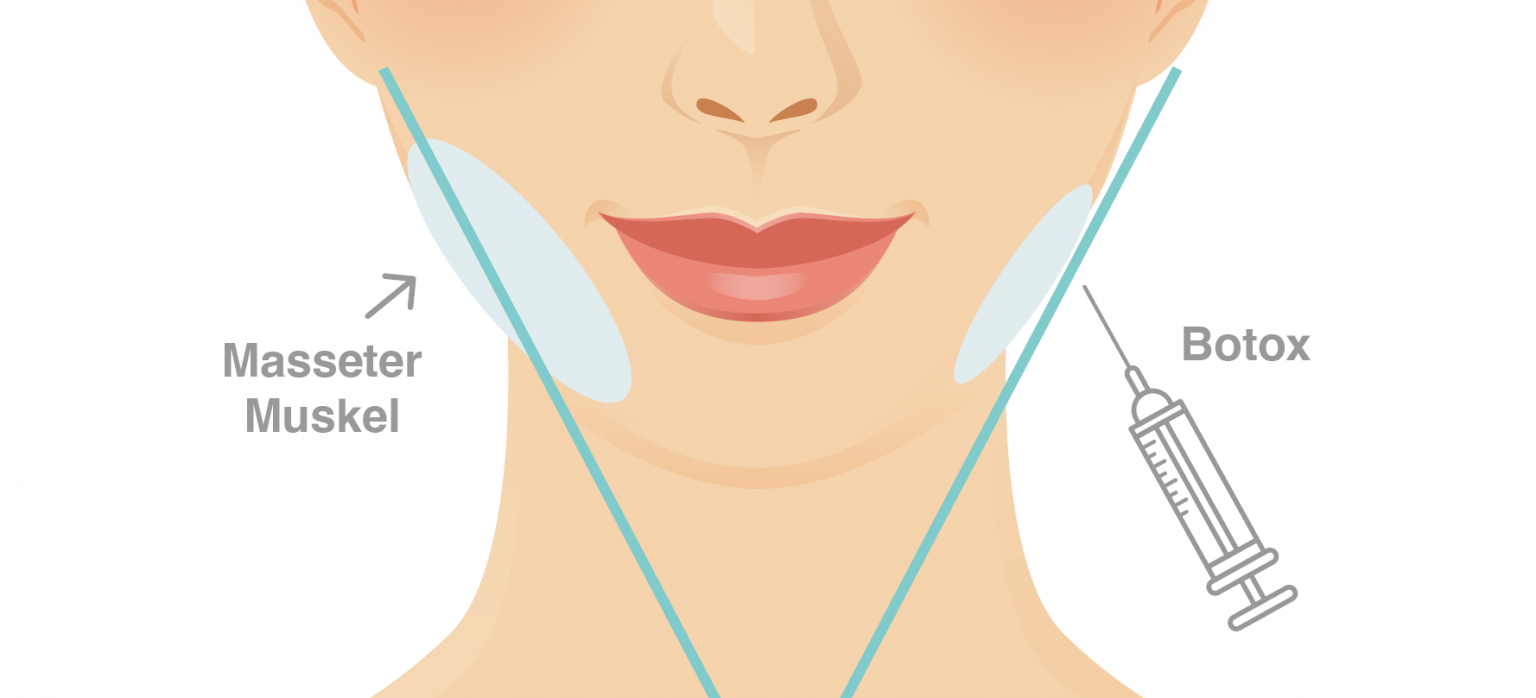 Sollte Man Botox Vorbeugend Nehmen www.hautok.de