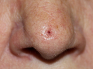 shutterstock_1333555172 Basaliom an der Nase.