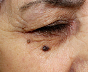 Basaliom am Auge.
