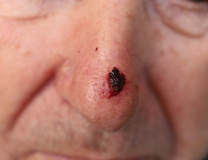 shutterstock_1961273341 Basaliom an der Nase.